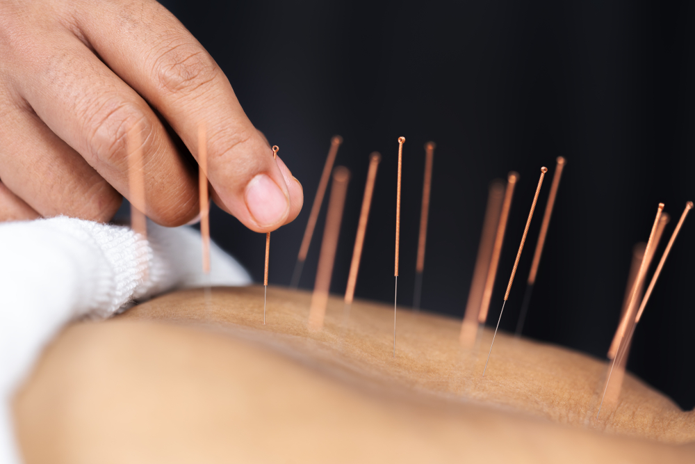 Quels sont les bienfaits de l’acupuncture pour les seniors ? 